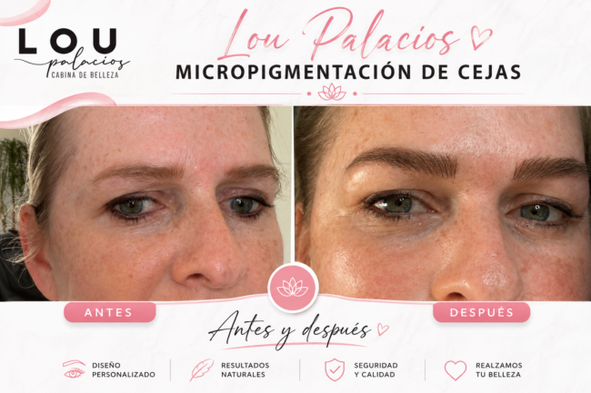 Lou Palacios Antes y después de micropigmentación de cejas en Cancún micropigmentación estética, micropigmentación paramédica, corrección de micropigmentación, cejas en Cancún, camuflaje de cicatrices.